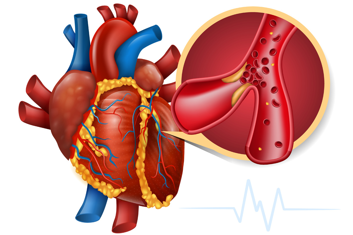 Kalp Damar Hastalıkları EKG de çıkar mı?